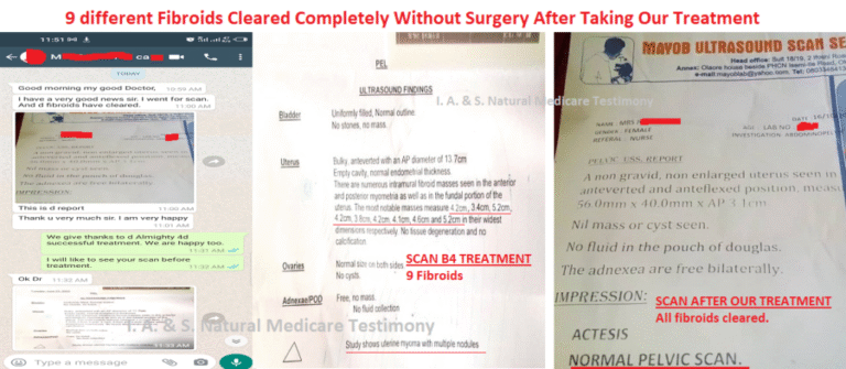 fib-2-9-fibroids-cleared-1024x447-1-768x335