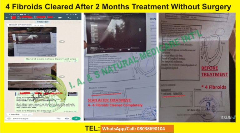 fib-3.-4-Fibroids-Cleared-After-2-Months-Treatment-Without-Surgery-1024x567-1-768x425