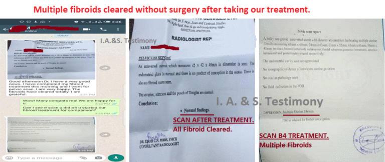 fib-6.-5-fibroids-cleared-Oct-1024x432-2-768x324